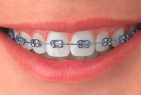 tipo de brackets metalicos|proceso para poner brackets.